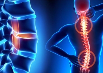 Bel Fıtığı Nedir?