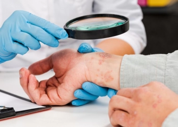 Cilt Hastalıkları için Bitkisel Reçeteler