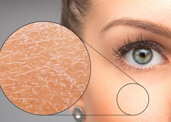 Ciltte Oluşan Çatlaklar Nasıl Geçer?